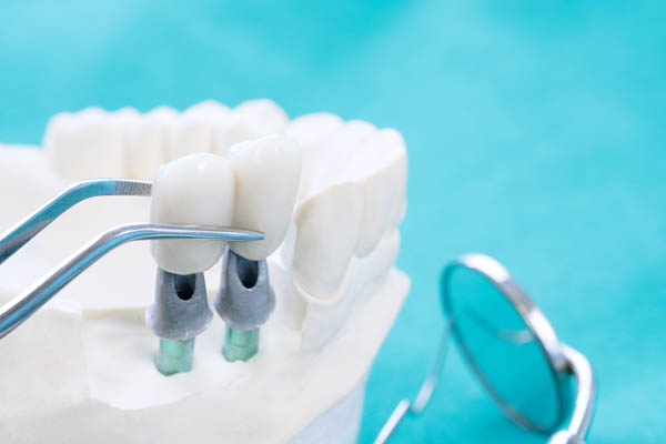 When Is A Dental Crown Necessary?