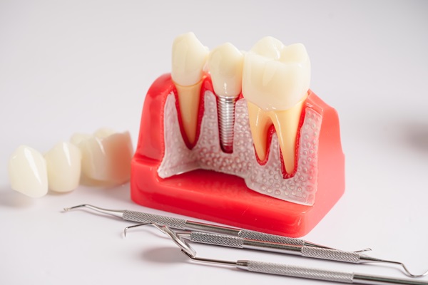 Who Is A Candidate For Dental Implants?