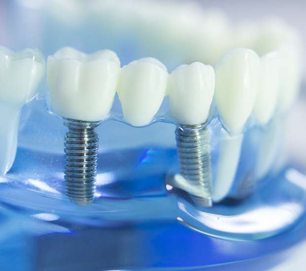 Van Nuys Dental Implants