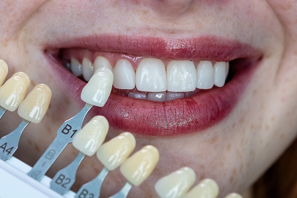 Dental Veneers Vs  Dentures: What Is The Difference?