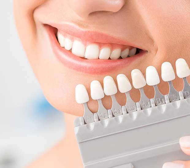 Van Nuys Dental Veneers and Dental Laminates