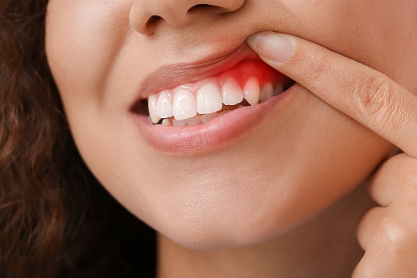 Can Gum Disease Be Prevented?