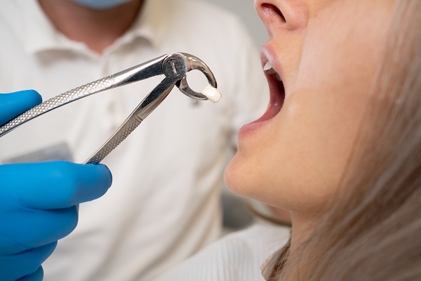 Wisdom Tooth Extraction And Top Reasons It Is Recommended