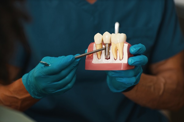 FAQs About Tooth Implants